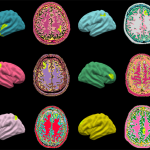 Aivomuutoksia tunnistava algoritmi voisi auttaa parantamaan epilepsian